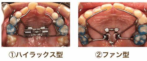 拡大期には鼻が横に広がる可能性も