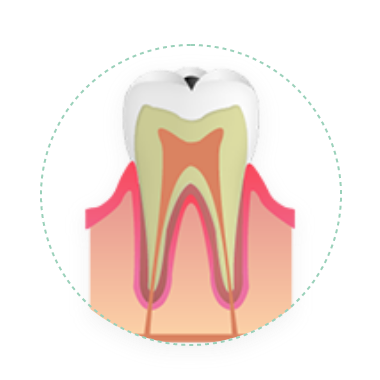 浅い虫歯（C1）