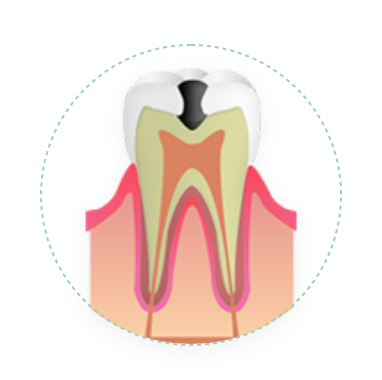 中程度の虫歯（C2）