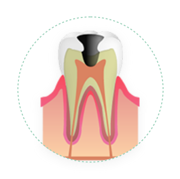 深い虫歯（C3）